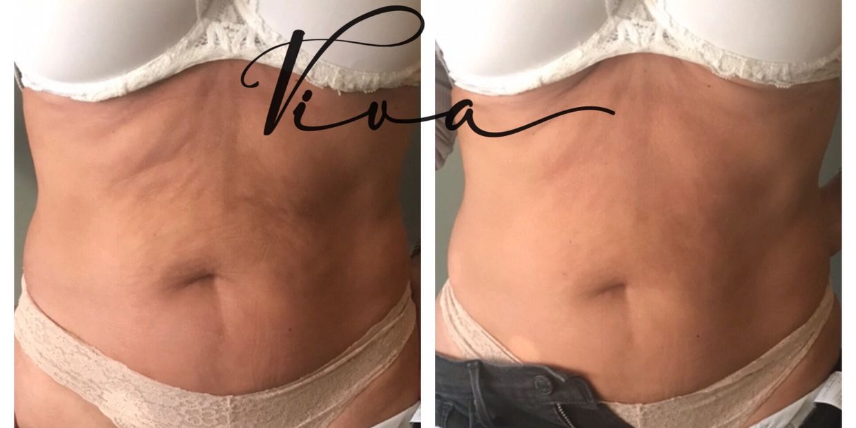 Stomach Tightening: Laser Skin Tightening Treatment