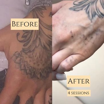 before and after laser tattoo removal results 
