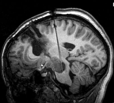 MRI scan showing a brain with a surgical needle inserted.