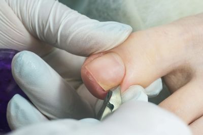 Toenail cutting in Sydney by podiatrist 