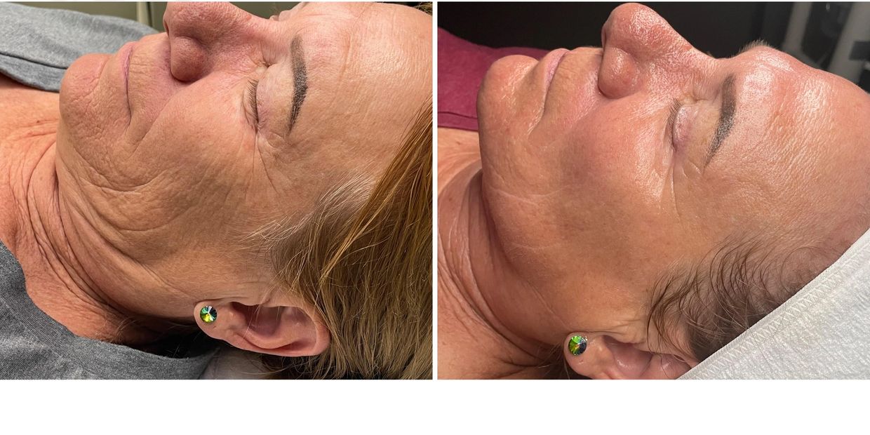 radio frequency skin tightening results, noninvasive anti-aging facial in Windsor, CO