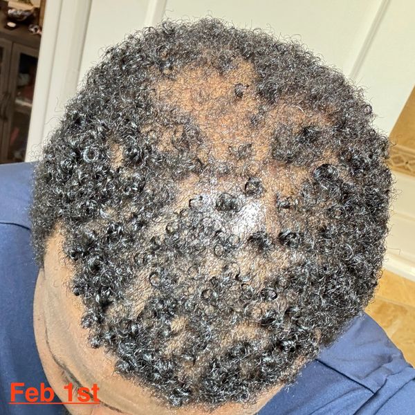 February 2025 growth check in. I started using my serum in January 2025. Focusing on my low density 