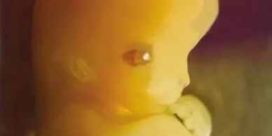 A baby in the 1st trimester with defined features; ears, eyes, nose, mouth and hands are visible.