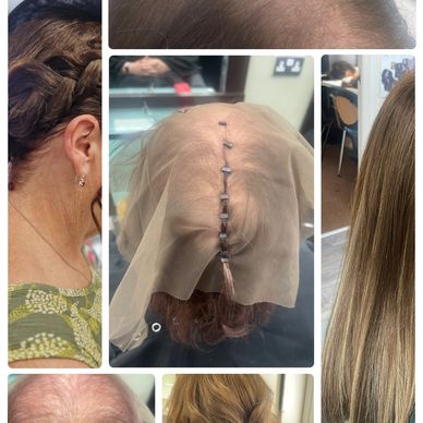 Collage showing hair loss, scalp treatment, and hair restoration results.