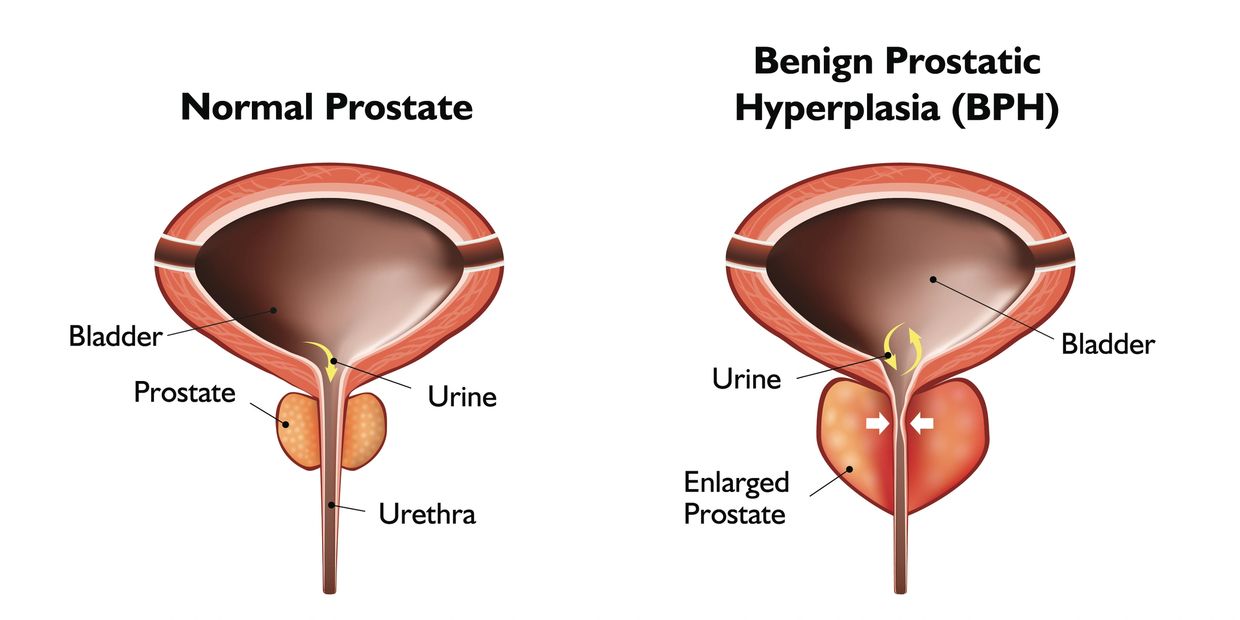 Picture of enlarged prostate