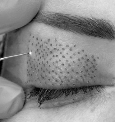 #fibroblast #fibroblastpen #skintightening