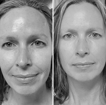 #facelift #skintightening