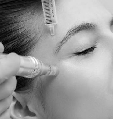 #microneedle #skintightening #skinresurfacing