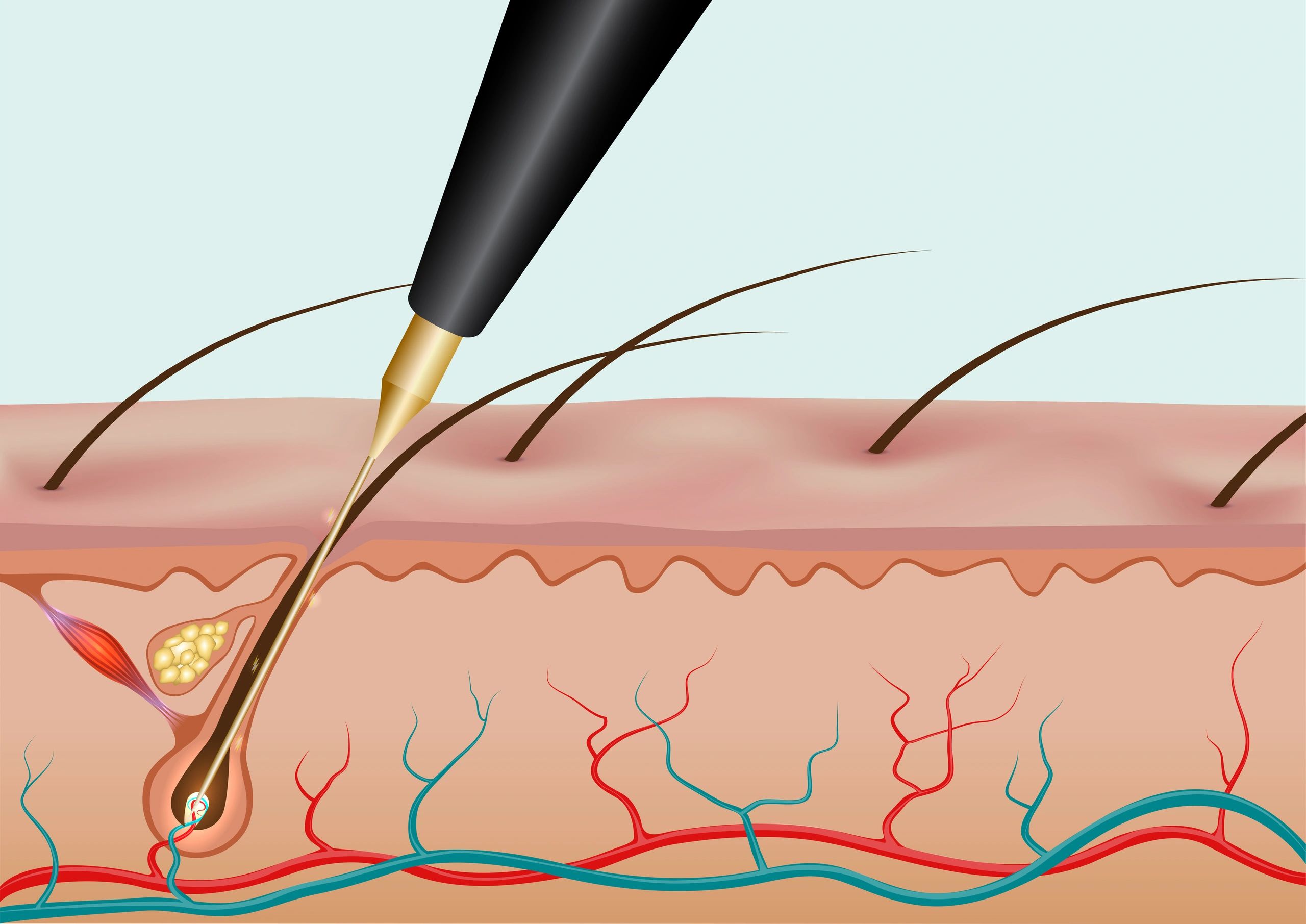 a close up of an Electrolysis probe being inserted into a hair follicle for permanent hair removal