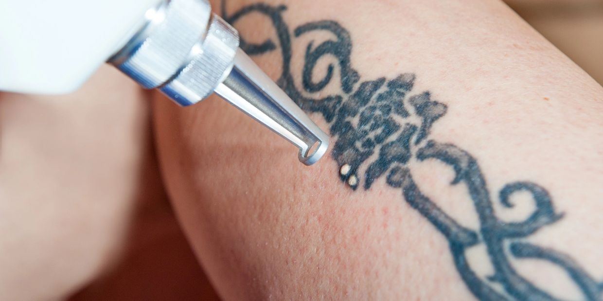 Laser tattoo removal treatment being performed on a blue/black tattoo  