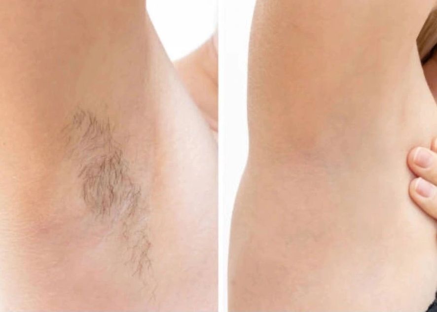 Comparison of armpits before and after hair removal.