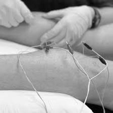 Chiropractor dry needling patient's knee with electrical muscle stimulation attached.