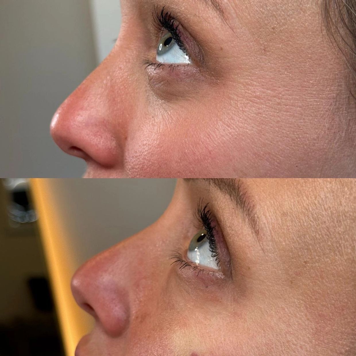 PDGF Skin & Undereye Rejuvenation | Ariya Aesthetics NH