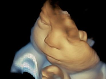 3D Ultrasound Face Picture at 33 Weeks Pregnant.
