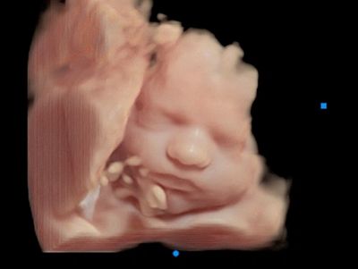 3D Ultrasound Face Picture with Hands