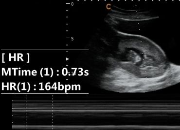 2D Ultrasound picture at 11 weeks 1 day pregnant of Baby's hart rate measured in M-mode.