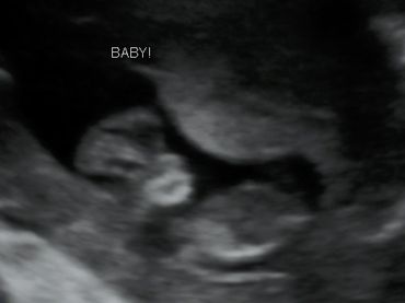 2D Ultrasound picture at 11 weeks 1 day pregnant of Baby laying in the uterus