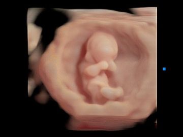 3D ultrasound picture of 1st trimester baby.