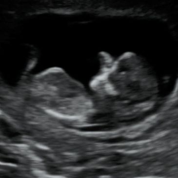 2D Ultrasound Picture of baby' s body profile at 11 Weeks 5 Days Pregnant.