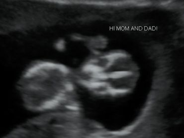 Baby's body 2D ultrasound images. Baby is 12 weeks and 3 days.