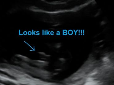 2D Ultrasound picture at 18 weeks pregnant, looks like a Boy!