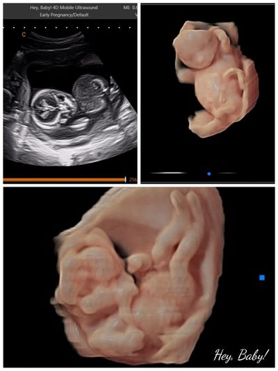 2D ultrasound and 3D ultrasound picture 1st trimester