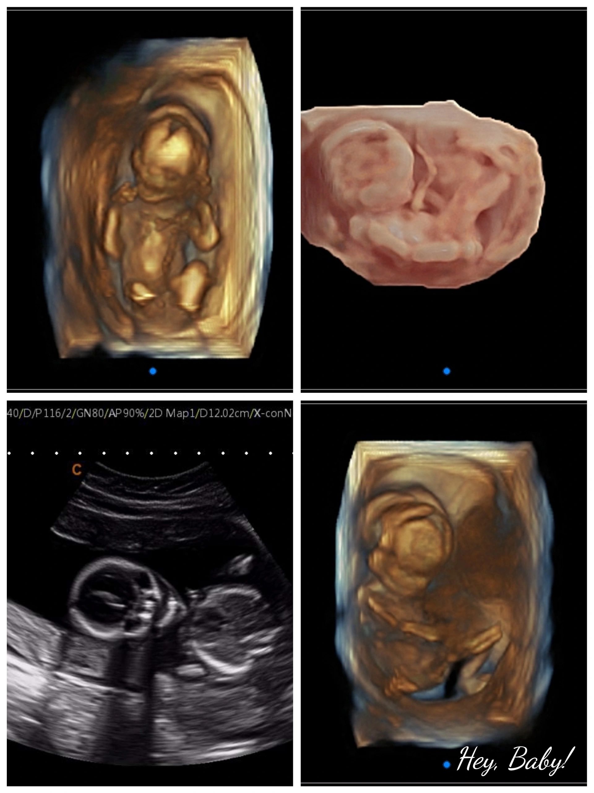 20 weeks ultrasound gender