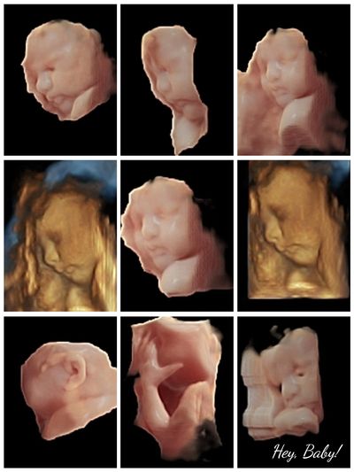 3D ultrasound baby picture