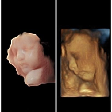 Baby 3D Ultrasound Picture side by side pictures