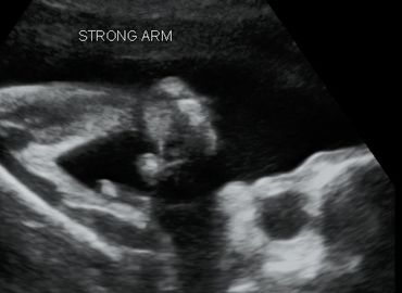 2D Ultrasound arm picture at 28 weeks pregnant.