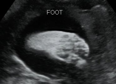 2D Ultrasound Foot Picture at 28 weeks pregnant.