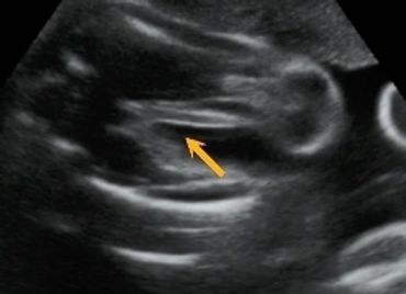 2D Ultrasound Girl Gender Picture at 28 weeks pregnant.