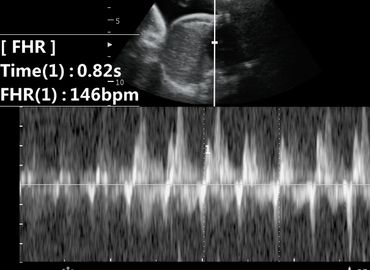 2D Ultrasound Heart Rate Picture at 28 weeks pregnant.