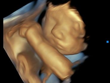 3D Ultrasound Face Picture at 28 weeks pregnant.
