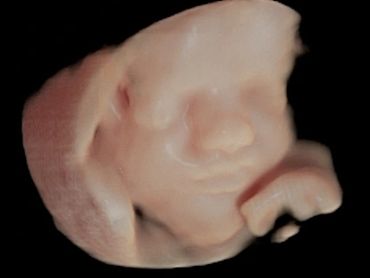 3D Ultrasound Face Picture at 28 weeks pregnant.