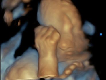 3D Ultrasound Fist Picture at 28 weeks pregnant.