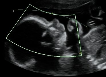 2D Ultrasound profile picture at 26 weeks