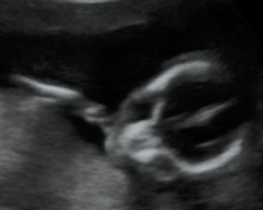 2D ultrasound baby picture face and right arm