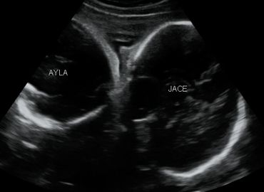 2D ultrasound picture of Baby A (Jace,) & Baby B's (Ayla,) heads next to each other at 30 weeks.
