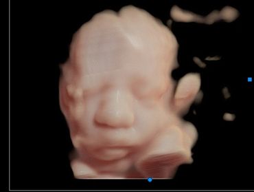 3D face ultrasound picture of Baby B at 30 weeks.