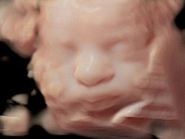 3D Ultrasound Picture at 32 Weeks pregnant of baby's face in virtual HD.