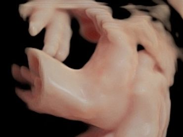 3D ultrasound picture at 32 weeks pregnant, of baby's foot.