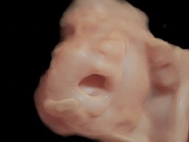 3D ultrasound picture at 32 weeks pregnant of baby yawning.
