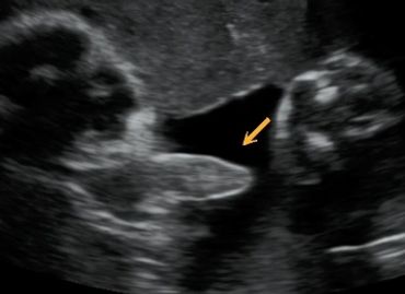 2D Ultrasound Boy Gender Picture at 33 Weeks Pregnant.