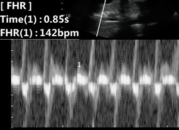 2D Ultrasound Heart Rate Picture at 33 Weeks Pregnant.