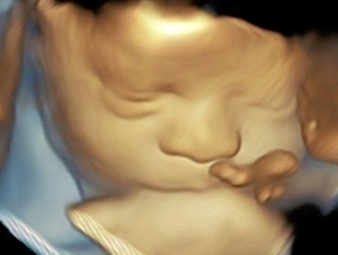 3D Ultrasound Face Picture at 33 Weeks Pregnant with eyes closed.