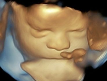 3D Ultrasound Face Picture at 33 Weeks Pregnant with the eyes open.