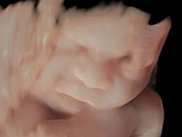 3D Ultrasound Face Picture in Virtual HD at 33 Weeks Pregnant of baby's face.