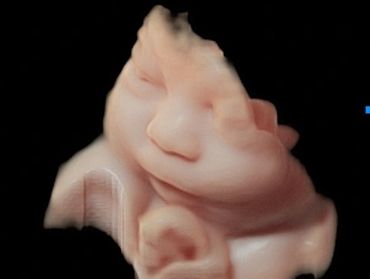 3D Ultrasound Face Picture in Virtual HD at 33 Weeks Pregnant of baby's face.