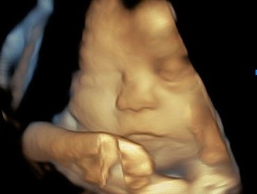 3D Ultrasound Face Picture at 33 Weeks Pregnant.